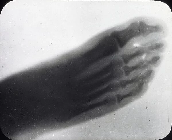 X-Ray - Human Foot