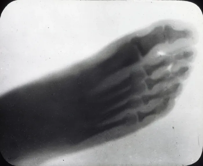 Framed Print : X-Ray - Human Foot Framed Print : X-Ray - Human Foot