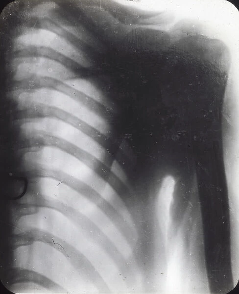 X-Ray - Human Male Chest