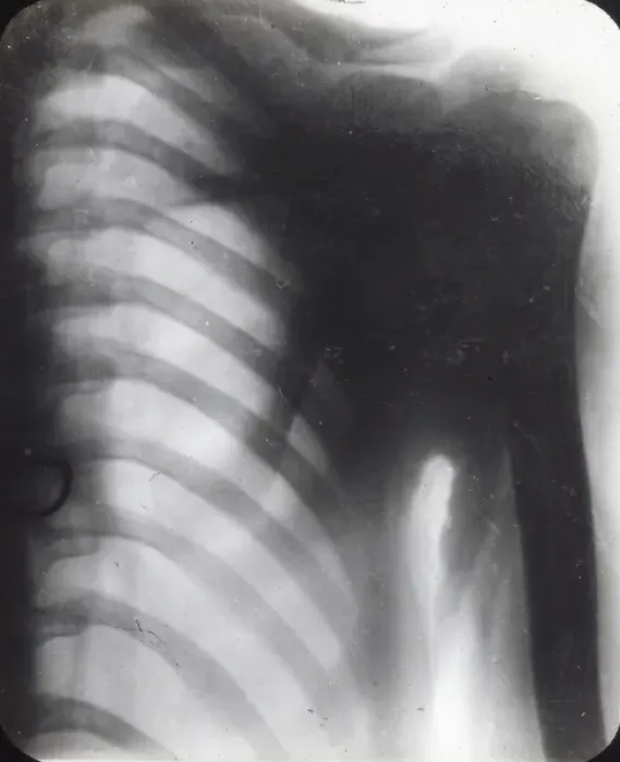 Framed Print : X-Ray - Human Male Chest Framed Print : X-Ray - Human Male Chest
