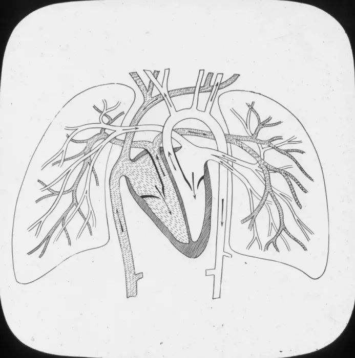 Framed Print : X-Ray - Pulmonary Circulation Framed Print : X-Ray - Pulmonary Circulation