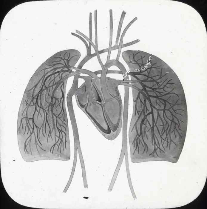 Framed Print : X-Ray - Pulmonary Circulation Framed Print : X-Ray - Pulmonary Circulation