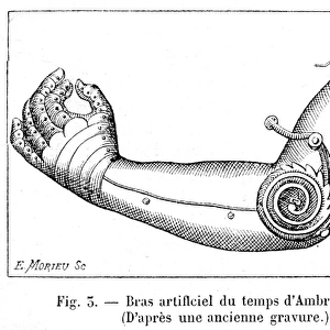 Artificial arm by Ambroise Par