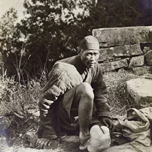 China - Chinese Beggar with severe elephantiasis of the foot