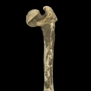 Humerus of Achondroplastic Dwarf