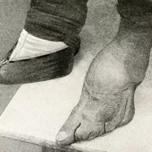 Shocking result of binding girls feet, China, East Asia