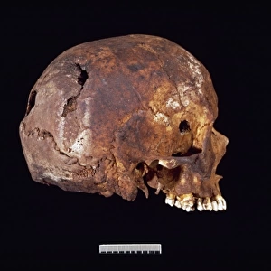 Skull showing bullet hole in right temple