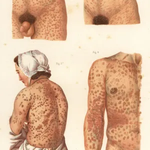 Syphilis symptoms on the body