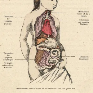 Tuberculosis Sufferer