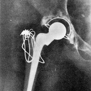 X-ray hip joint replacement