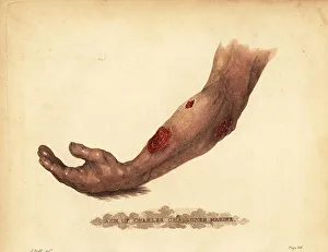 Wounds Prints: Abscess from a gunshot wound in the forearm, 1815