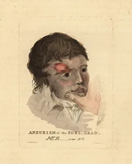 Wounds Prints: Aneurysmal tumor on the forehead of a young man, 1815
