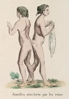 Deformities Prints: Attached Twins