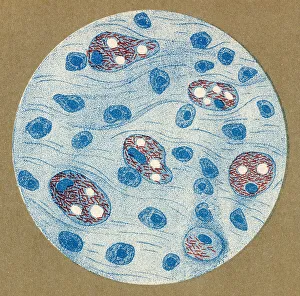 Bacillus Prints: Bacillus of leprosy discovered by Hansen, 1877