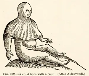 Child Birth Prints: Born with a Caul