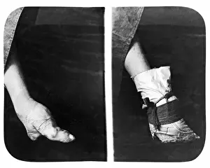 Painful Prints: Bound foot, China