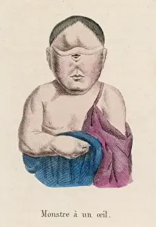 Child with One Eye