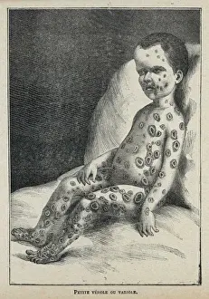 Child with Smallpox