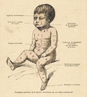 Syphilis Prints: Child with Syphilis