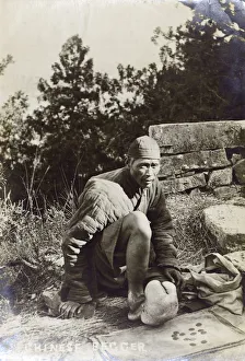 Pity Gallery: China - Chinese Beggar with severe elephantiasis of the foot