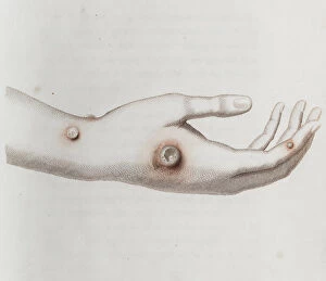 Smallpox Collection: Coloured depiction of lesion on a hand
