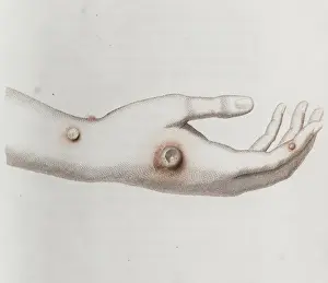 Vaccination Prints: Coloured depiction of lesion on a hand