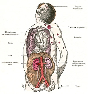 Inflicted Gallery: Diagram / Diabetes / 1883