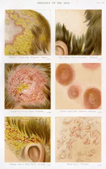 Images Dated 9th November 2017: Diseases of the Skin - Plate 4