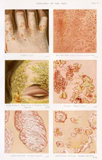 Images Dated 9th November 2017: Diseases of the Skin - Plate 5