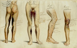 Adm101 Gallery: Effects of Scurvy