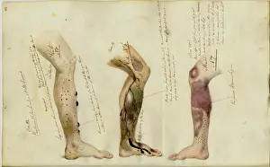 Effects of Scurvy