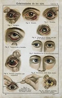Healing Gallery: Enfermedades de los ojos (Eye diseases). Engraving