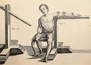 Equipment for dislocated arm. Image from the book