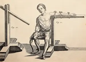 Achille Prints: Equipment for dislocated arm. Image from the book