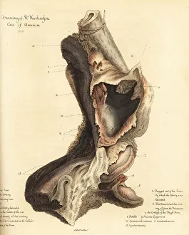 Wounds Prints: Fatal aneurysmal sac from the broken leg of a man, 1815