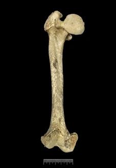 Mersekha Collection: Femur of Achondroplastic Dwarf