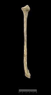 Mersekha Collection: Fibula of Achondroplastic Dwarf