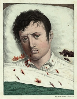Images Dated 16th April 2012: The final stages of yellow fever