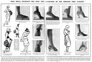 Foot x rays showing damage done by wearing high heels