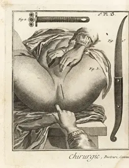 Fouberts surgical operation to remove a bladder stone