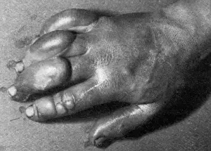 Swollen Prints: Frostbitten hand of Edward Atkinson, Antarctic expedition 19