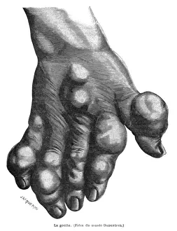 Symptoms Prints: Gout Symptoms on Hand