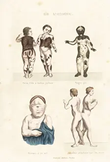 Steelengraving Prints: Human disorders