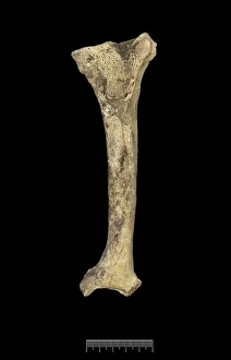 Tibia Collection: Humerus of Achondroplastic Dwarf