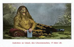 Lionel, The Lion-faced Man - Very Hairy Man