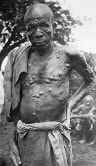 Disease Gallery: Man with leprosy, Mombasa, Kenya, East Africa