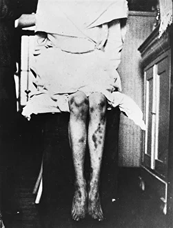 Harry Price Library Gallery: Marasco Stigmata - 2