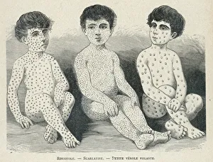 Spot Collection: Measles Compared
