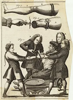Amputation Gallery: Medical / Amputation / Arm