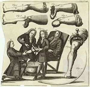1739 Gallery: Medical / Amputation / Leg